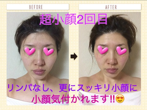 超小顔2回目♥ 超小顔2回目♥