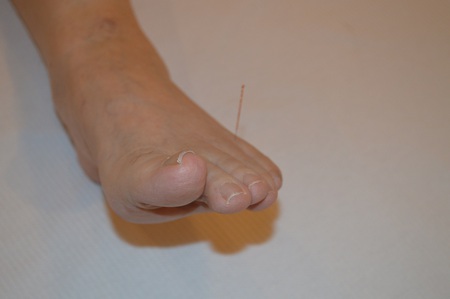 膝痛の鍼治療症例(65) 膝痛の鍼治療症例(65)