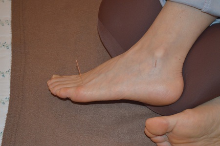 慢性腰痛の鍼治療症例(21) 慢性腰痛の鍼治療症例(21)