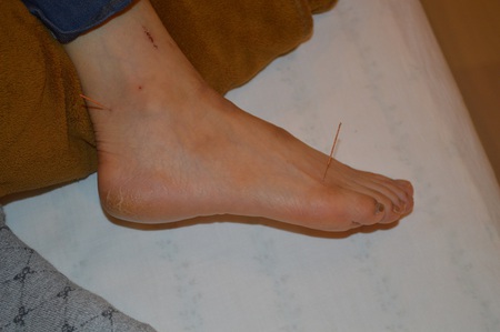 腰痛の鍼治療症例(22) 腰痛の鍼治療症例(22)