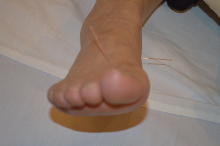 膝痛の鍼治療症例(29) 膝痛の鍼治療症例(29)