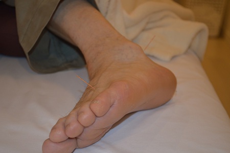 ぎっくり腰の鍼治療症例(17) ぎっくり腰の鍼治療症例(17)