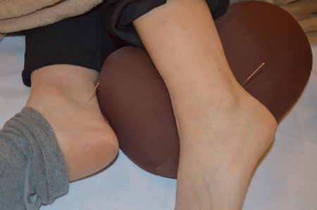 腰痛の鍼治療症例(28) 腰痛の鍼治療症例(28)