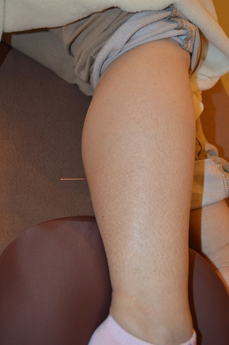 腰痛の鍼治療症例(29) 腰痛の鍼治療症例(29)