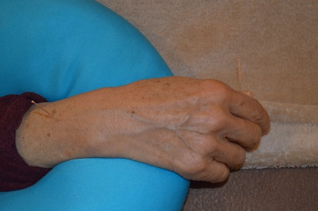 手のしびれの鍼治療症例(3) 手のしびれの鍼治療症例(3)