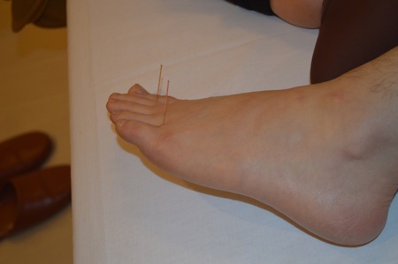 腰痛の鍼治療症例(33) 腰痛の鍼治療症例(33)