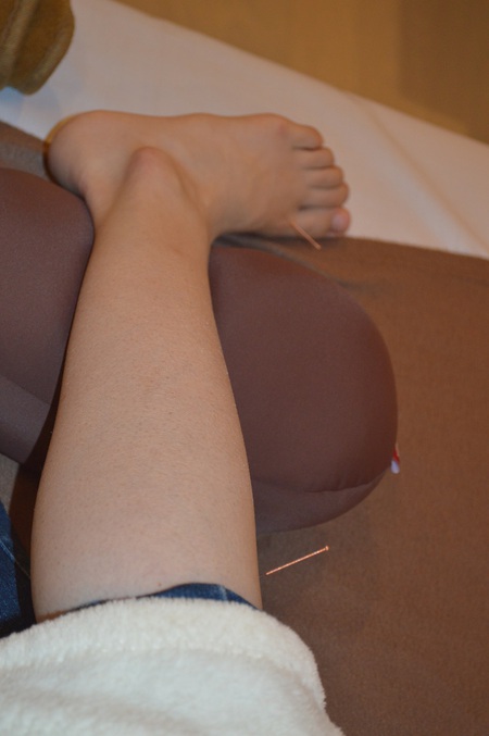 腰痛の鍼治療症例(36) 腰痛の鍼治療症例(36)