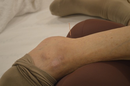 ぎっくり腰の鍼治療症例(23) ぎっくり腰の鍼治療症例(23)
