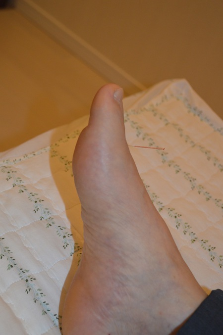 足のむくみの鍼治療症例(30) 足のむくみの鍼治療症例(30)