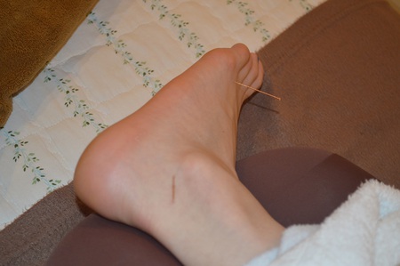 腰痛の鍼治療症例(38) 腰痛の鍼治療症例(38)