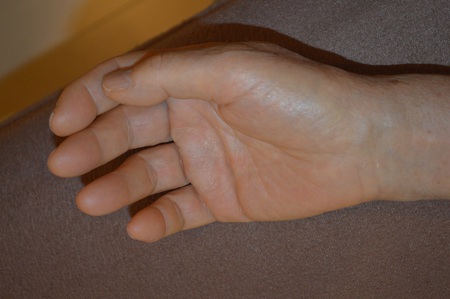 手の腫れの鍼治療症例(4) 手の腫れの鍼治療症例(4)