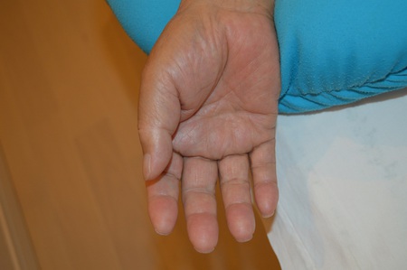 手の腫れの鍼治療症例(5) 手の腫れの鍼治療症例(5)