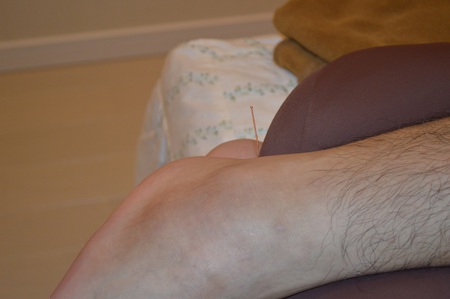 腰痛の鍼治療症例(42) 腰痛の鍼治療症例(42)