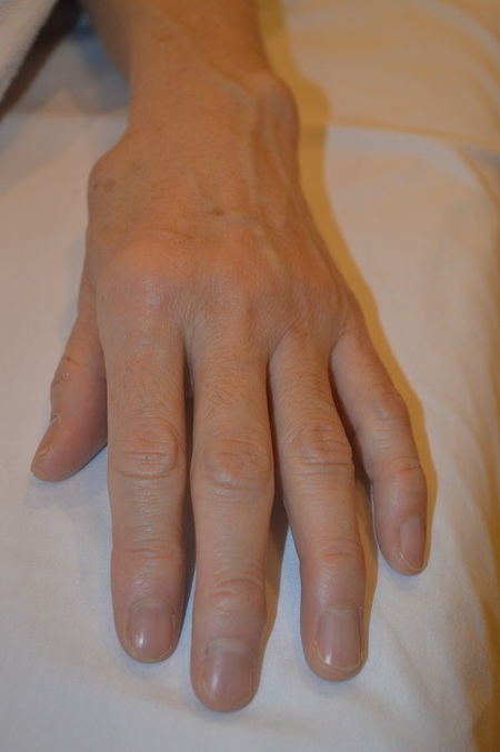 手の腫れの鍼治療症例(11) 手の腫れの鍼治療症例(11)