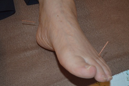 膝痛の鍼治療症例(52) 膝痛の鍼治療症例(52)
