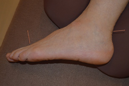腰痛の鍼治療症例(52) 腰痛の鍼治療症例(52)