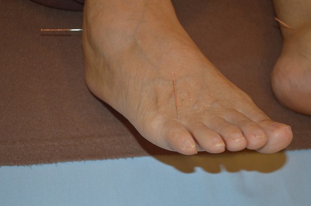 腰痛の鍼治療症例(56) 腰痛の鍼治療症例(56)