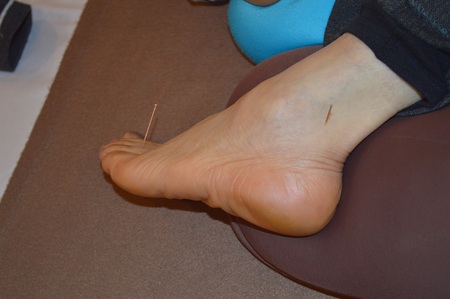 腰痛の鍼治療症例(60) 腰痛の鍼治療症例(60)