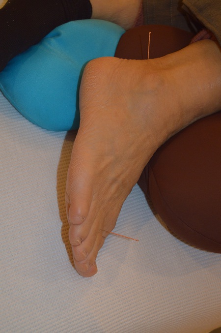 腰痛の鍼治療症例(63) 腰痛の鍼治療症例(63)