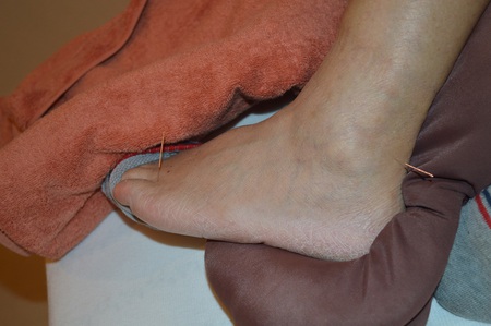 腰痛の鍼治療症例(79) 腰痛の鍼治療症例(79)