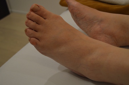 むくみの鍼治療症例(125) むくみの鍼治療症例(125)