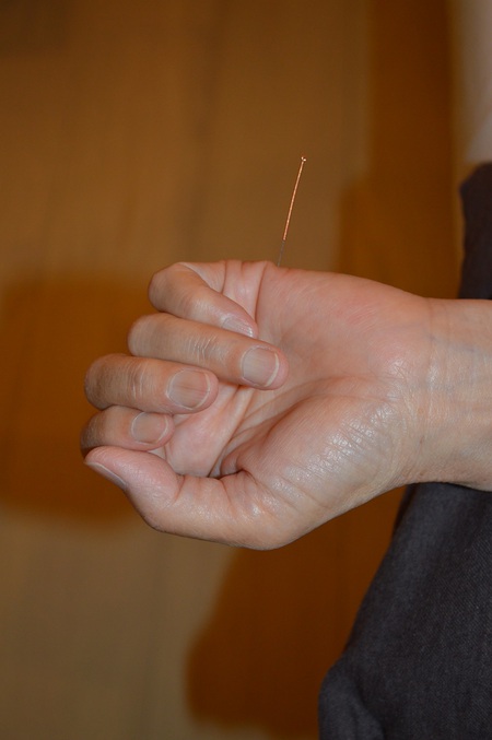 頚部痛の鍼治療症例(40) 頚部痛の鍼治療症例(40)