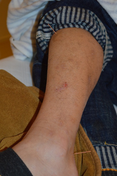 腰痛の鍼治療症例(94) 腰痛の鍼治療症例(94)
