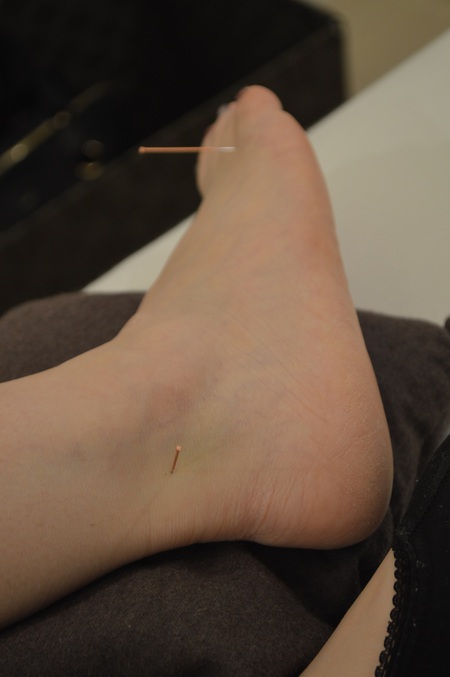 腰痛の鍼治療症例(100) 腰痛の鍼治療症例(100)