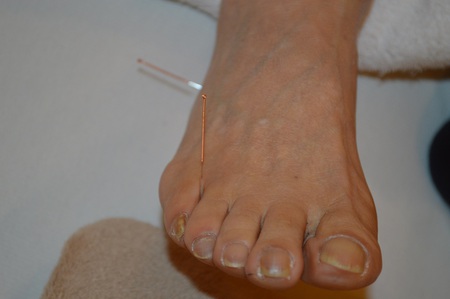 ぎっくり腰の鍼治療症例(86) ぎっくり腰の鍼治療症例(86)