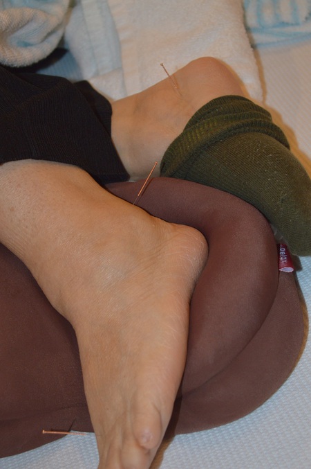 ぎっくり腰の鍼治療症例(87) ぎっくり腰の鍼治療症例(87)