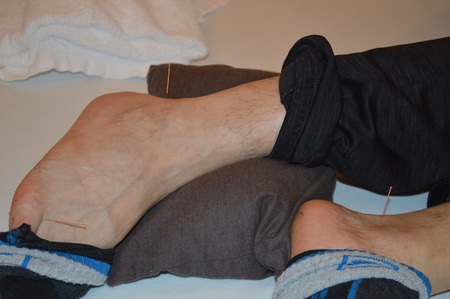 腰痛の鍼治療症例(101) 腰痛の鍼治療症例(101)