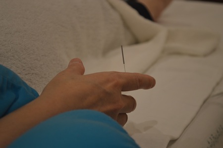肩関節痛の鍼治療症例(33) 肩関節痛の鍼治療症例(33)