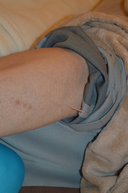 腰痛の鍼治療症例(32) 腰痛の鍼治療症例(32)