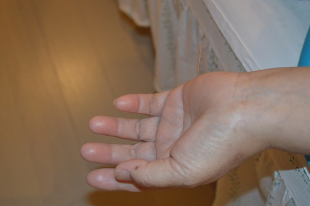 ぎっくり腰の治療症例(26) ぎっくり腰の治療症例(26)