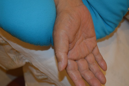 手の腫れの鍼治療症例(5) 手の腫れの鍼治療症例(5)