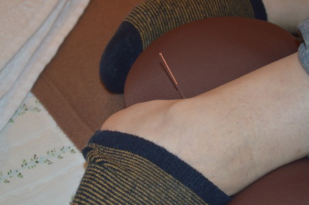腰痛の鍼治療症例(45) 腰痛の鍼治療症例(45)