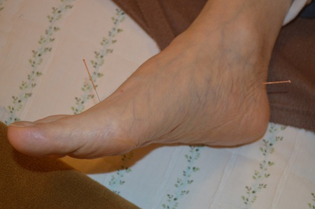 膝痛の鍼治療症例(58) 膝痛の鍼治療症例(58)