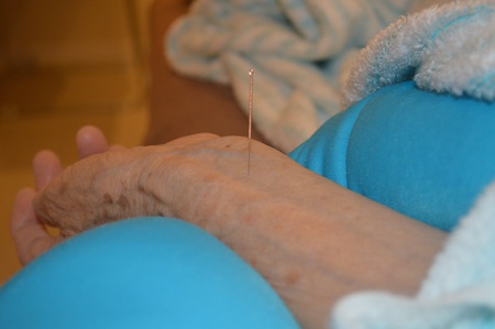 膝痛の鍼治療症例(64) 膝痛の鍼治療症例(64)
