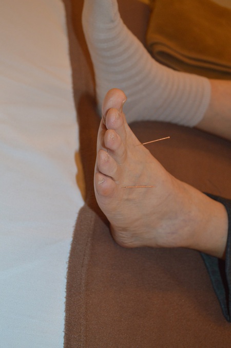 膝痛の鍼治療症例(72) 膝痛の鍼治療症例(72)