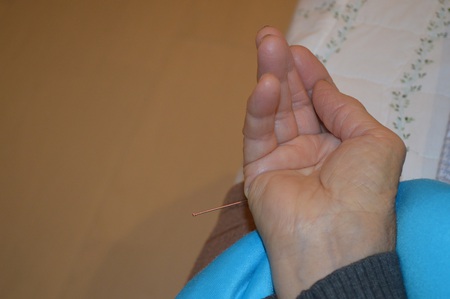 ぎっくり腰の鍼治療症例(67) ぎっくり腰の鍼治療症例(67)