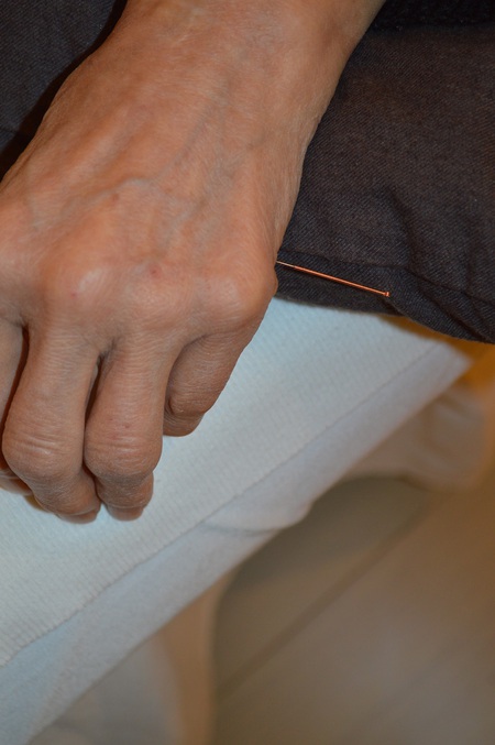 ぎっくり腰の鍼治療症例(86) ぎっくり腰の鍼治療症例(86)
