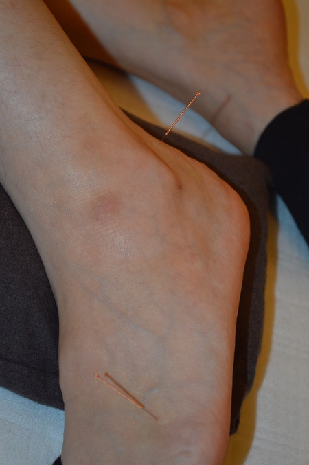 腰痛の鍼治療症例(102) 腰痛の鍼治療症例(102)