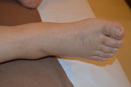 むくみの鍼治療症例(56) むくみの鍼治療症例(56)