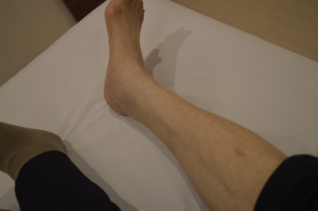 むくみの鍼治療症例(60) むくみの鍼治療症例(60)