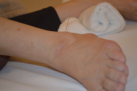 ぎっくり腰の鍼治療症例(35) ぎっくり腰の鍼治療症例(35)
