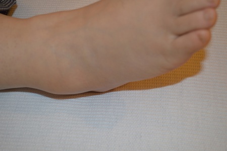 捻挫の鍼治療症例(7) 捻挫の鍼治療症例(7)