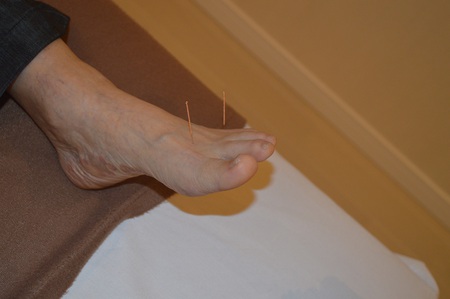 膝痛の鍼治療症例(77) 膝痛の鍼治療症例(77)