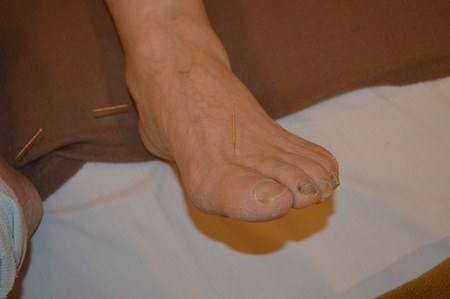 膝痛の鍼治療症例(79) 膝痛の鍼治療症例(79)