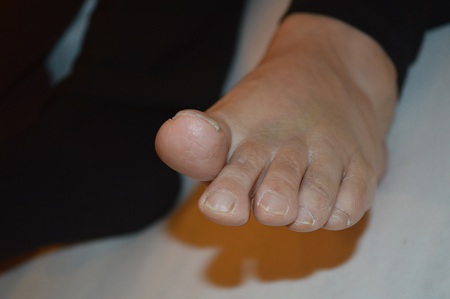 打撲の鍼治療症例(6) 打撲の鍼治療症例(6)