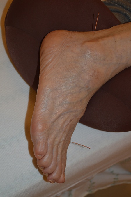腰痛の鍼治療症例(70) 腰痛の鍼治療症例(70)